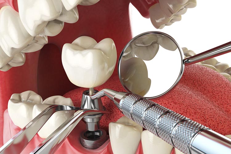 dental implants lekki lagos