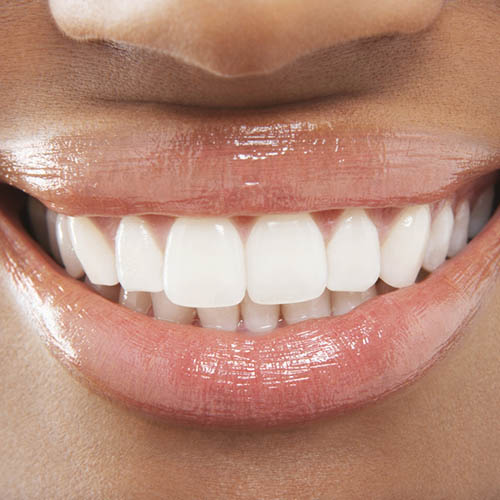 teeth whitening lekki lagos